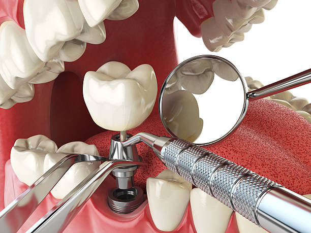 Best Emergency Tooth Extraction in Winchester, OH